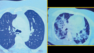 İlaç kullanmayı reddeden koronavirüs hastasının röntgeni ağızları açık bıraktı